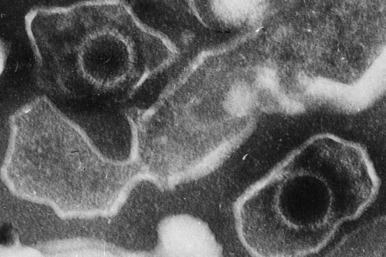 Энг кўп тарқалган вирус саратон қўзғатувчиси экани маълум бўлди