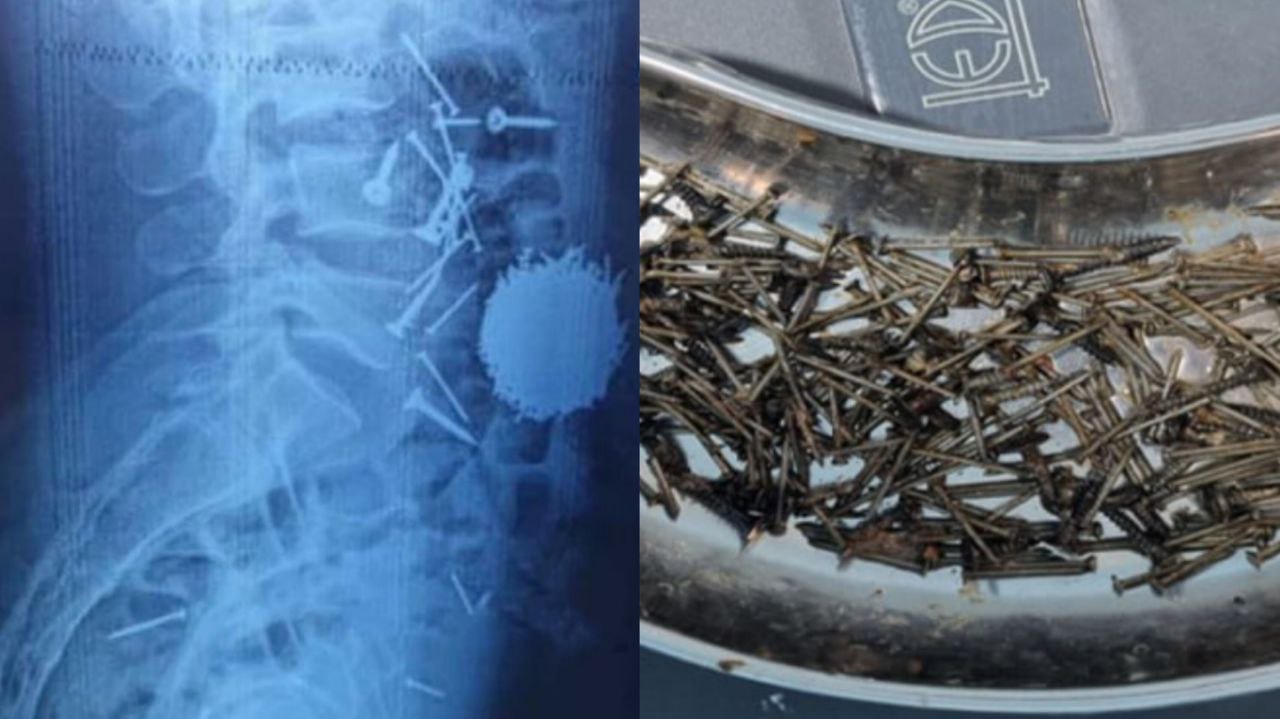 Самарқанд шаҳрида шифокорлар бемор танасидан тахминан 200 грамм мих ва винтларни олиб чиқишди