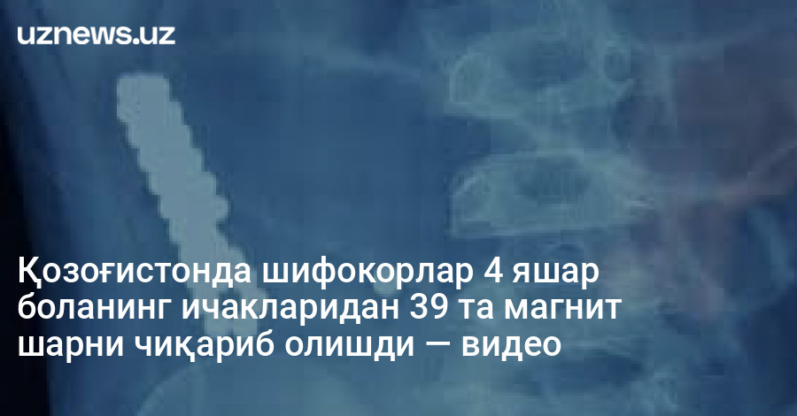 Қозоғистонда шифокорлар 4 яшар боланинг ичакларидан 39 та магнит шарни чиқариб олишди — видео